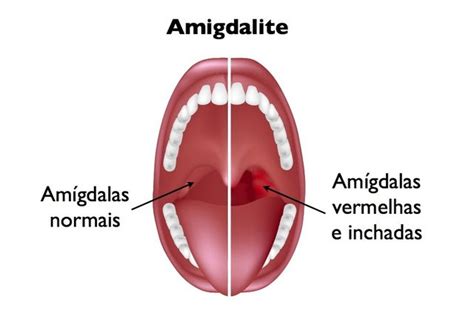 Amigdalite O Que Quando Viral Ou Bacteriana E Tratamento Tua Sa De