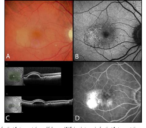 Figure 1 From Retention Of Good Visual Acuity In Eyes With Neovascular