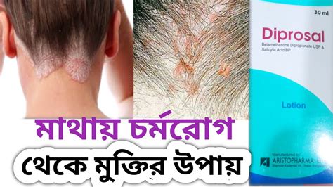 Diprosal lotion মথর এলরজ থক মকতর সহজ উপয YouTube