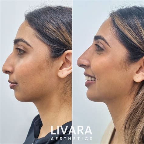 Non Surgical Rhinoplasty Pros Cons Of Nose Filler Treatments