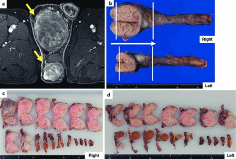 Radiologic And Gross Findings A A Contrast Enhanced Magnetic Resonance