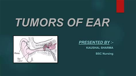 Tumors Of Ear Ppt Free Download