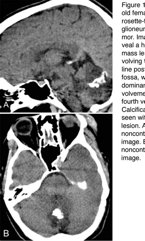 Figure 1 From Rosette Forming Glioneuronal Tumor Of The Fourth