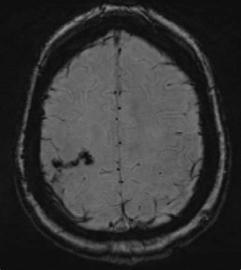 Cerebral Venous Sinus Thrombosis Secondary To Acute Cytomegalovirus