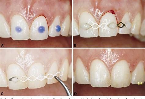 Figure From Splinting Of Traumatized Teeth With A New Device Tts