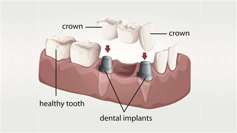 Whats Better For Replacing Teeth Dentures Or Dental Implants