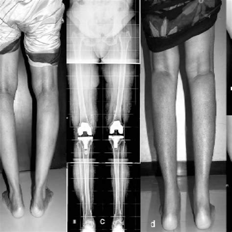 Year Old Female With Bilateral Genu Varum Deformity A B Shows