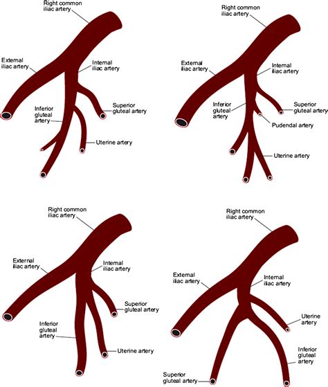 An Unusual Arterial Supply To The Uterus A Case Report And Review Of Anatomy Implications For