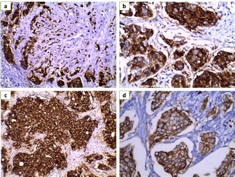 Immunohistochemical Expression Of Trop In Breast Carcinoma Brown