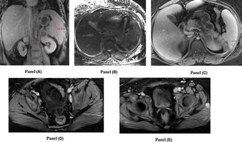 Initial Abdominal And Pelvic Mri A Splenomegaly Present With Download Scientific Diagram