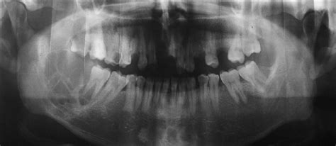 Panoramic Image Showing Multilocular And Radiolucent Lesion Extending