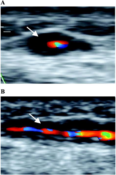 Diagnostic Value Of Color Doppler Ultrasonography Of Temporal Arteries