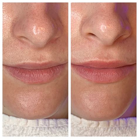 Best HydraFacial In Denver HydraFacial Before And After Mooi