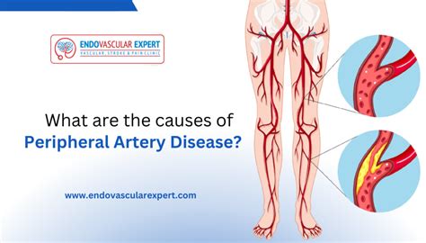 What Are The Causes Of Peripheral Artery Disease Dr Nikhil Bansal