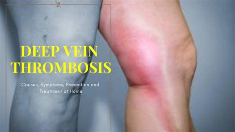 Deep Vein Thrombosis Causes Symptoms Prevention And Treatment At Home