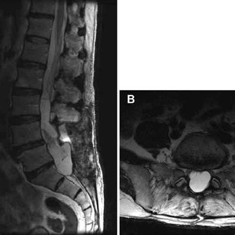 Postoperative Magnetic Resonance Imaging At 3 Months A The Arachnoid Download Scientific