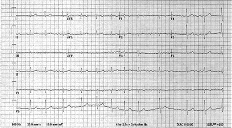 Electrocardiogram Showing Atrial Fibrillation With A Controlled Rate Of