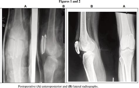 Figure From Internal Fixation Of Patella Fractures Using Cannulated