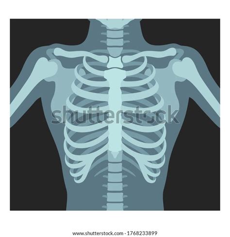 Thorax X Ray Lungs Radiological Control Radiography Of Chest Ribs