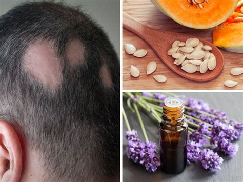 8 Best Home Remedies For Alopecia Areata And Hair Loss In Hindi