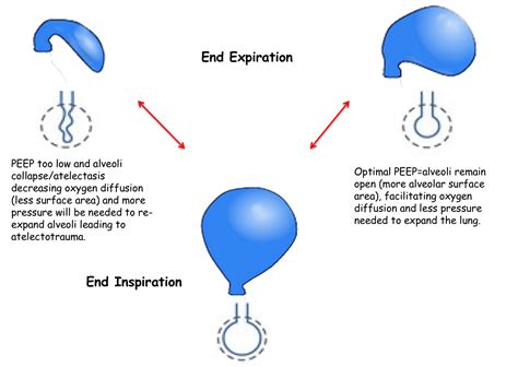 Optimal Peep Rebel Em Emergency Medicine Blog