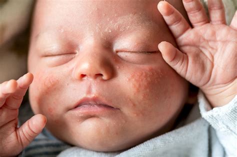 Eczéma chez le bébé Comment le reconnaître et comment le soulager