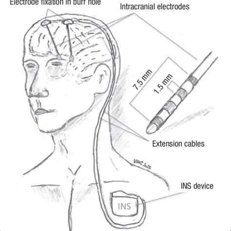 Different Varieties Of Dbs Electrode Dbs Deep Brain Stimulation A Download Scientific