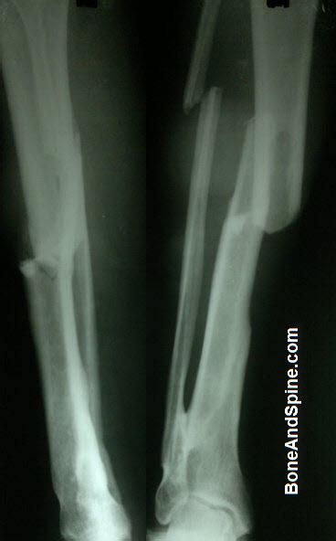 Spiral Fracture Distal Fibula