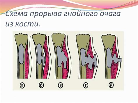 Острый гематогенный остеомиелит у детей - презентация онлайн