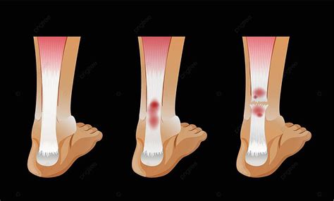 Diagram Showing Broken Bone In Human Foot Illustration Broken Bone ...