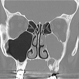 PDF Odontogenic Maxillary Sinusitis A Comprehensive Review