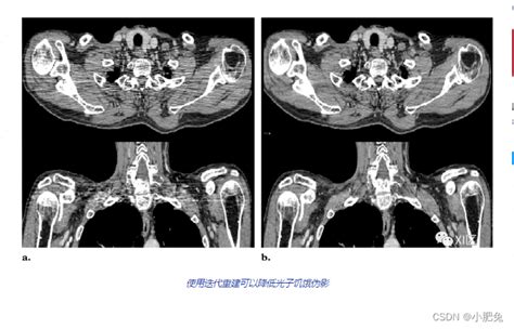 Ct伪影：根本原因与规避方法小鼠ct运动伪影 Csdn博客