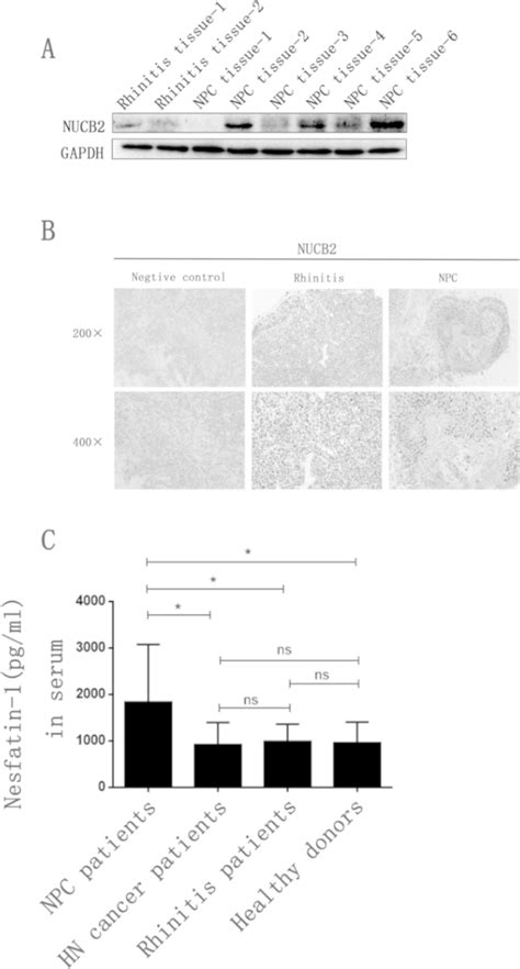 Comparison Of Of NUCB 2 Expression Between Samples Of Clinical NPC And