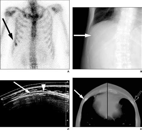 Figure From High Resolution Sonography Of The Rib Can Fracture And