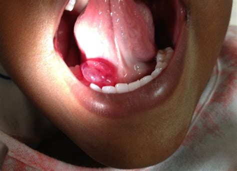 A Sublingual Mass In A 5 Year Old Male Jetem