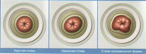 Convatec Пластины конвексные "Комбигезив 2S"/"Дурагезив" пластичные 13 ...