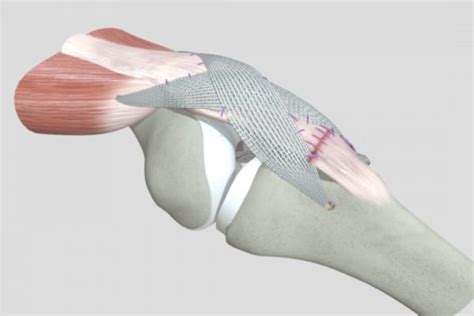 Lateral Resurfacing Elbow Ash 3d