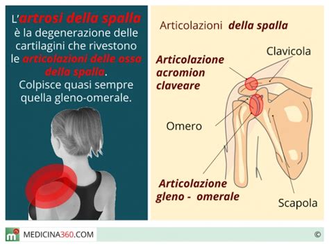 Artrosi Della Spalla Sintomi Cause Rimedi Ed Esercizi