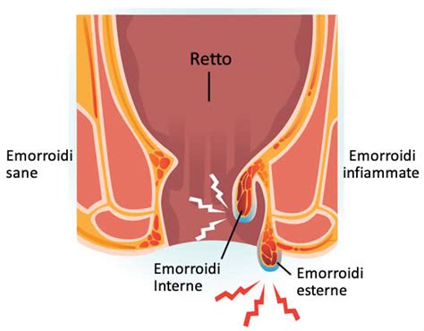 Emorroidi Esterne