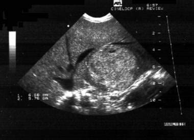 Liver Glycogen Storage Disease Ultrasound