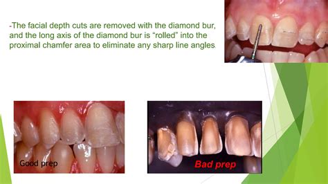 the Veneer step by step | PPT