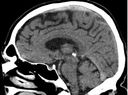 Inferior Sagittal Sinus Thrombosis Radiology