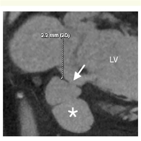 AV fistula aneurysm repair-a) the aneurysm as was typically found at ...