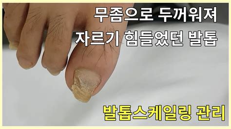 발톱무좀 경향과 치료법 만나보기 Thép Phú Châu