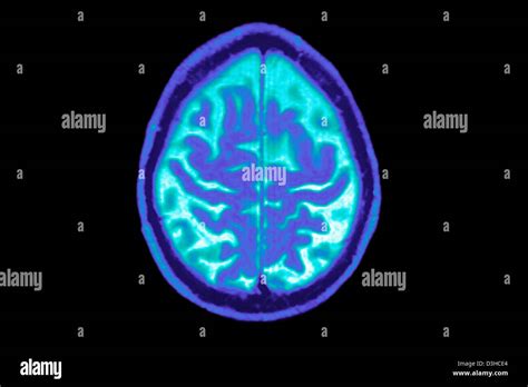 ALZHEIMER DISEASE, MRI Stock Photo - Alamy