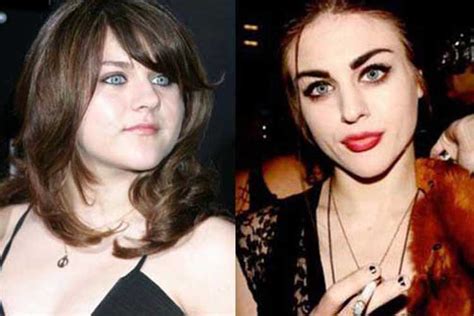 Frances Bean Cobain Plastic Surgery Chin Implants Breast Augmentation