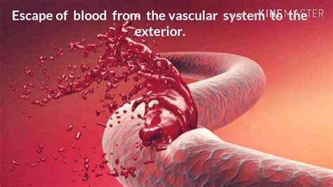 Haemorrhage Definition Types Part 1 Youtube