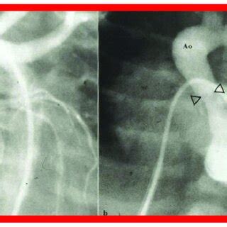 A Selected Frame From The Ascending Aorta Ao Cine Angiogram Prior