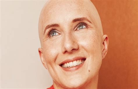 Hair Loss During Chemo - Oncovia