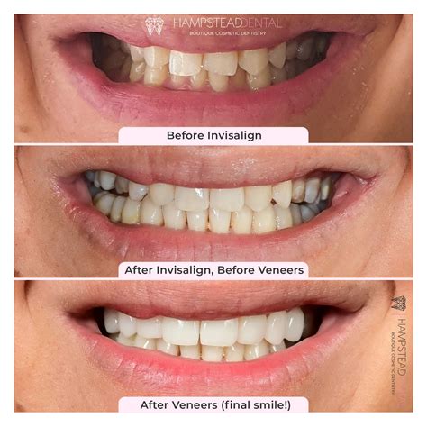 A Clear Path To A Perfect Smile The Benefits Of Invisalign Hampstead